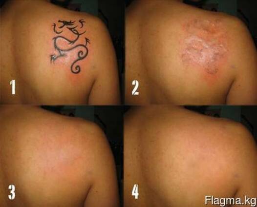 Удаление тату, татуировок, татуажа Бишкек, лазерный пилинг